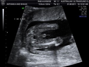 It's a boy! Ultrasound