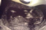 12 weeks 4 days Pregnant - Ultrasound