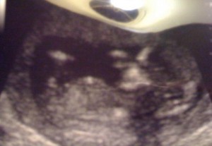 12 weeks 4 days Pregnant - Ultrasound
