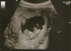 Ultrasound Picture - 10 weeks pregnant